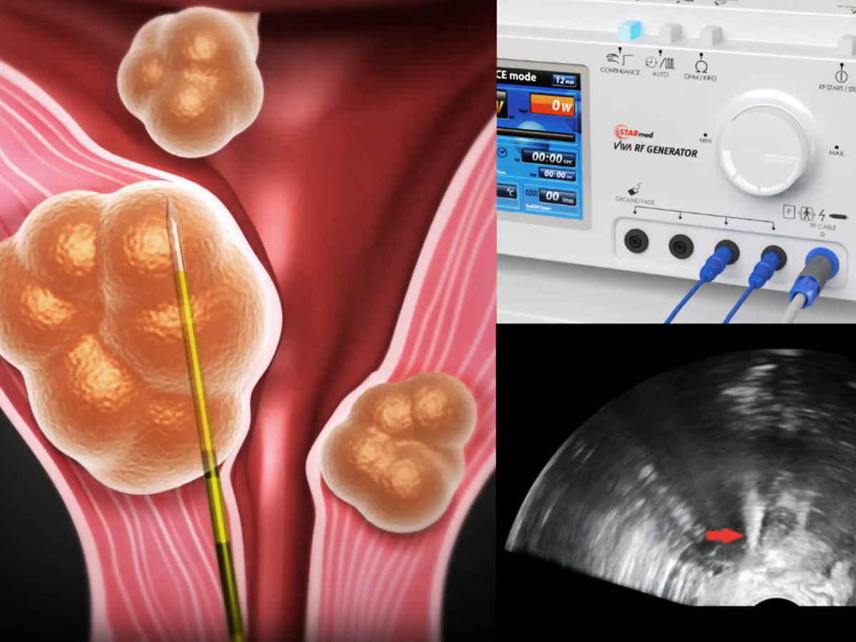 Illustration: Position der Elektrode im Uterus