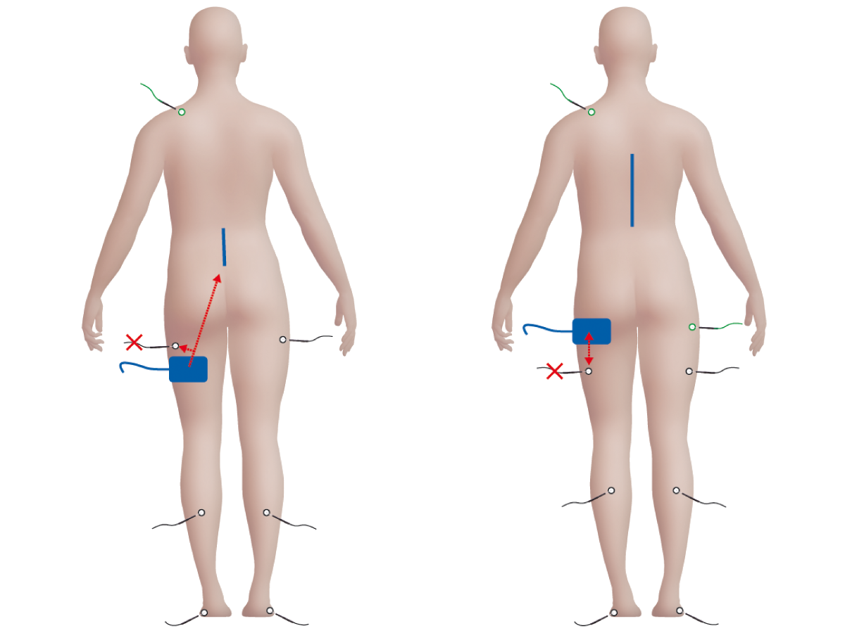 Illustration: Anatomische Position der Elektroden