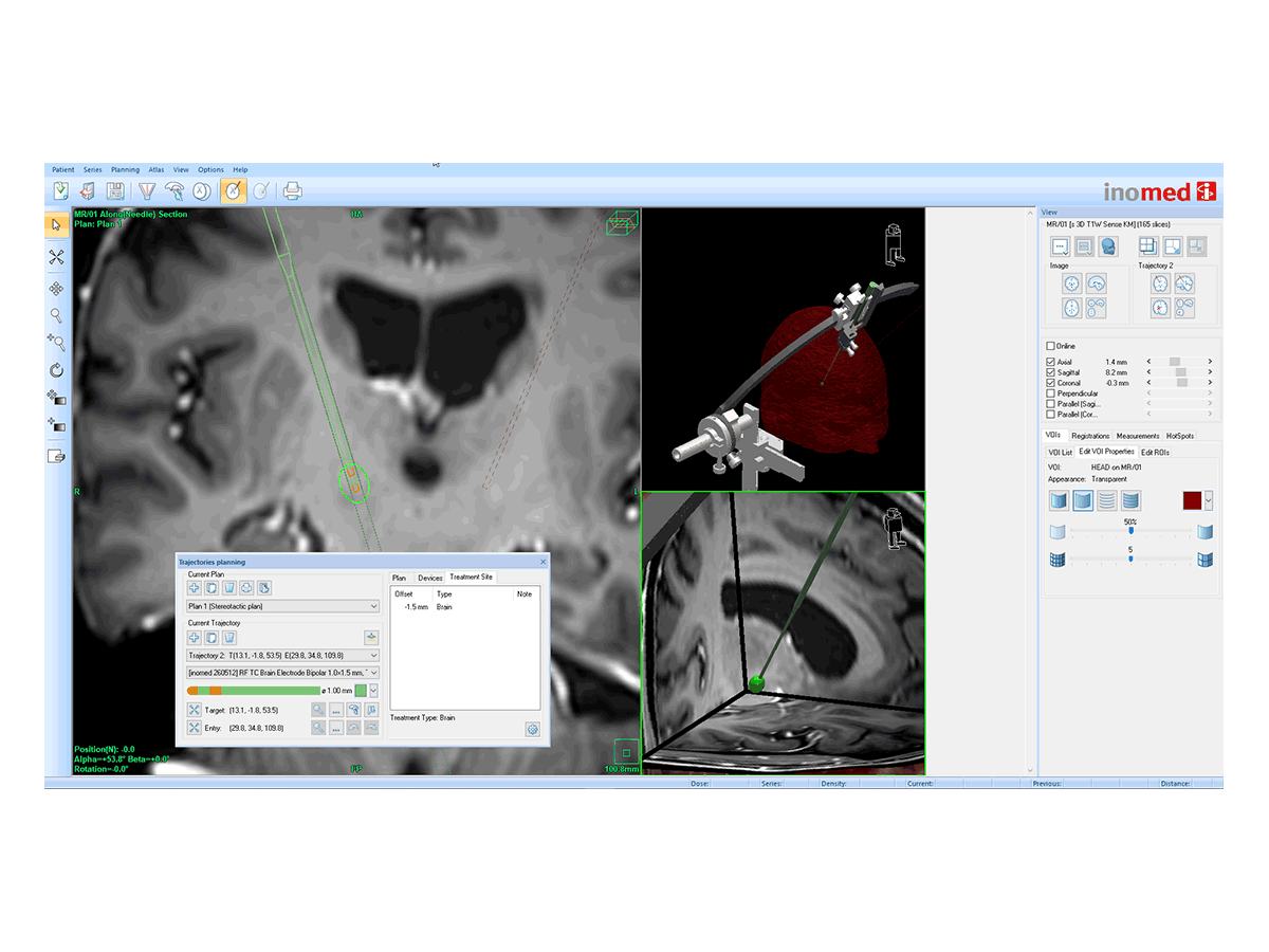 Volumen-Modul für iPS Planung für Läsionen