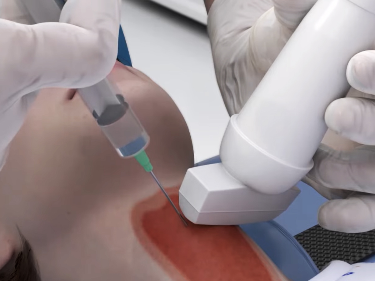 Grafik: Injektion des Betäubungsmittels