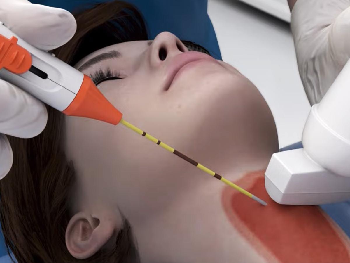 Grafik: Einführung der Elektrode