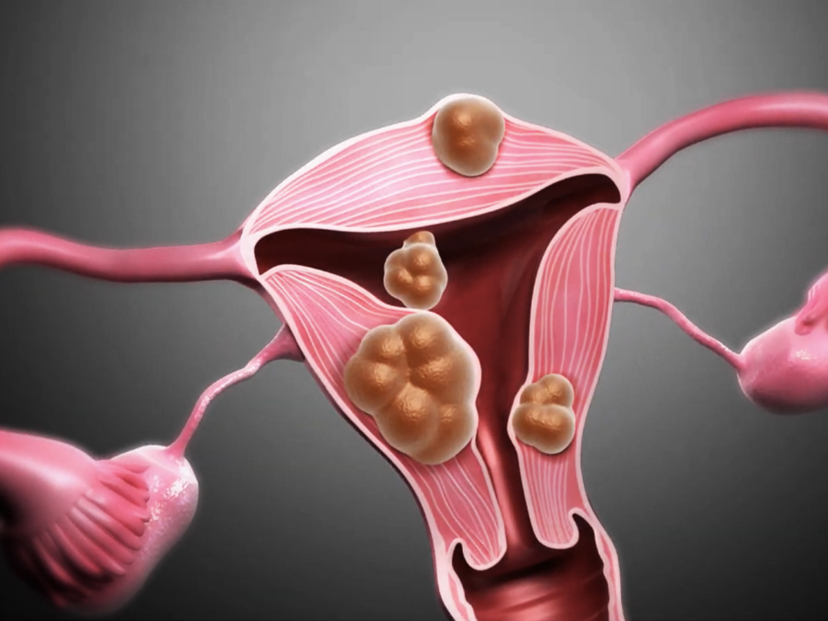 Illustration: uterine fibroids Illustration: uterine fibroids