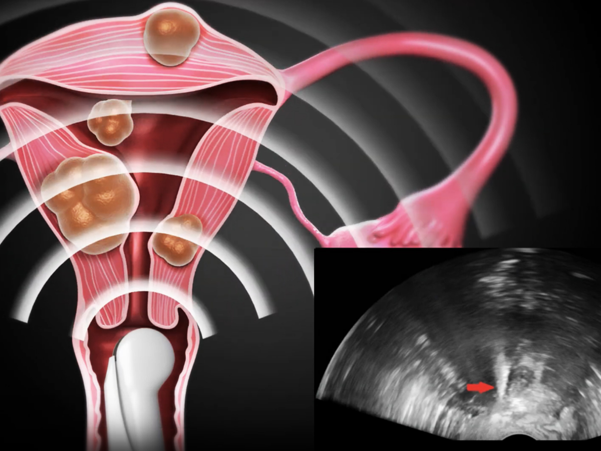 Illustration: electrode placement Illustration: electrode placement