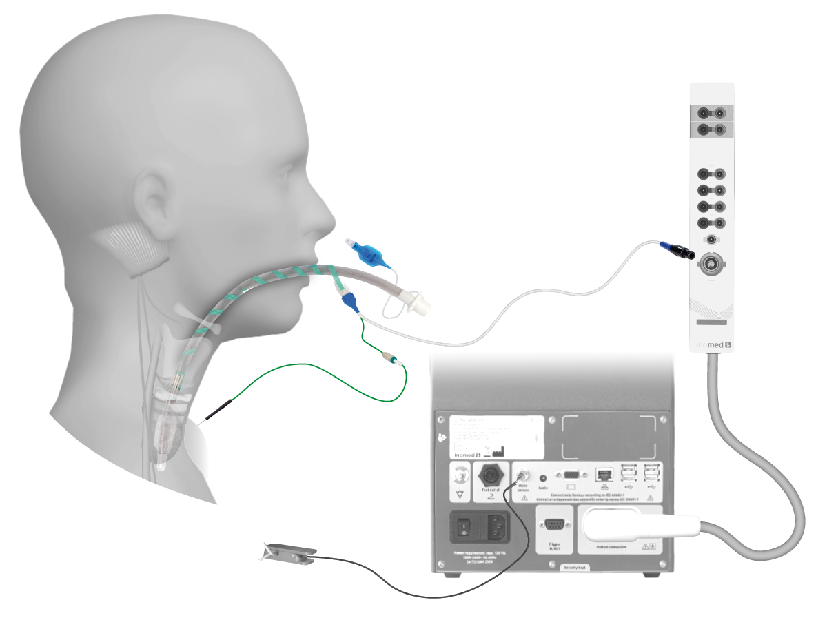Illustration: laryngeal tube electrode connection Illustration: laryngeal tube electrode connection