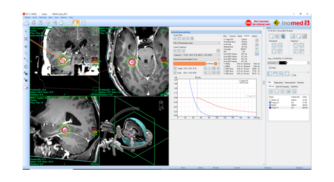 Brachytherapy module for iPS planning of seed implantation